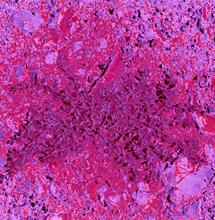 Cannabistherapie bei Fibromyalgie