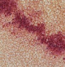 THC kann Parkinson-Symptome lindern