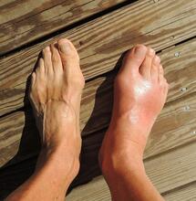 can cannabis work for gout disease? 