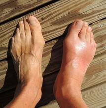 Cannabis gegen Gicht