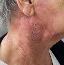 CBD y dermatitis atópica senil