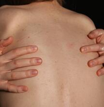 Terapia con cannabis per la fibromialgia