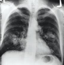 El cannabis en el tratamiento del cáncer de pulmón