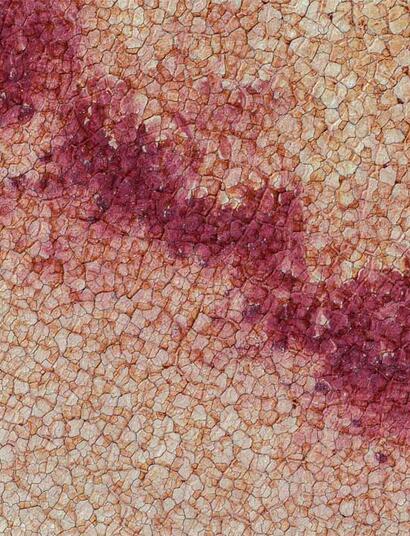 Cannabis kann helfen, Symptome der Parkinson-Krankheit zu lindern.