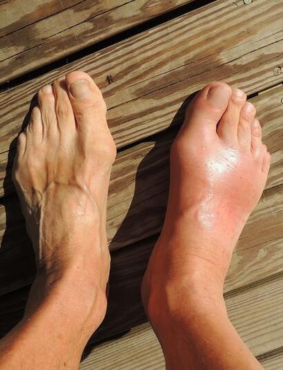 can cannabis work for gout disease? 