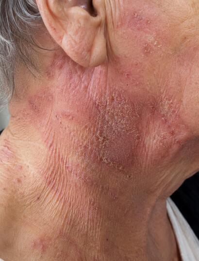 rostro de persona mayor con dermatitis