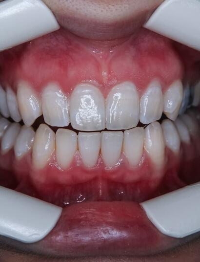 CBD-en-la-disfunción-temporomandibular-y-el-bruxismo
