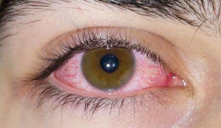 Zarudlé oči prozradí požití marihuany. Co s tím? 