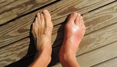 can cannabis work for gout disease? 