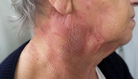 rostro de persona mayor con dermatitis